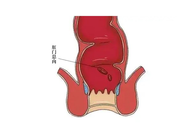 肛门息肉早期图片