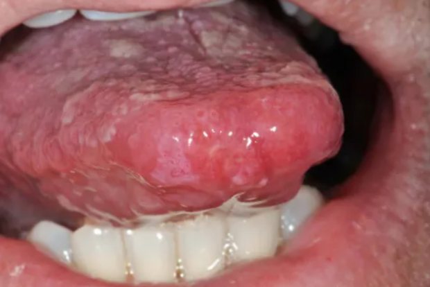 口腔硬下疳图片