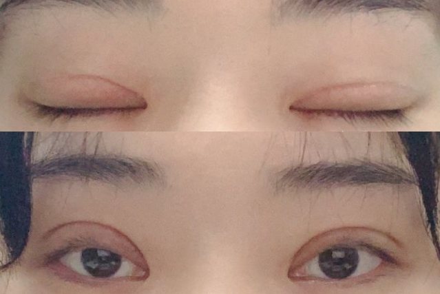 全切双眼皮16天图片