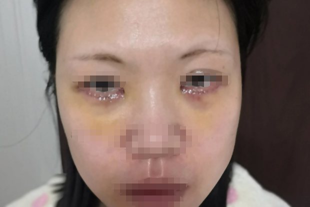 眼袋失败案例