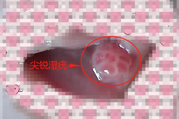 尖锐湿疣早期图片