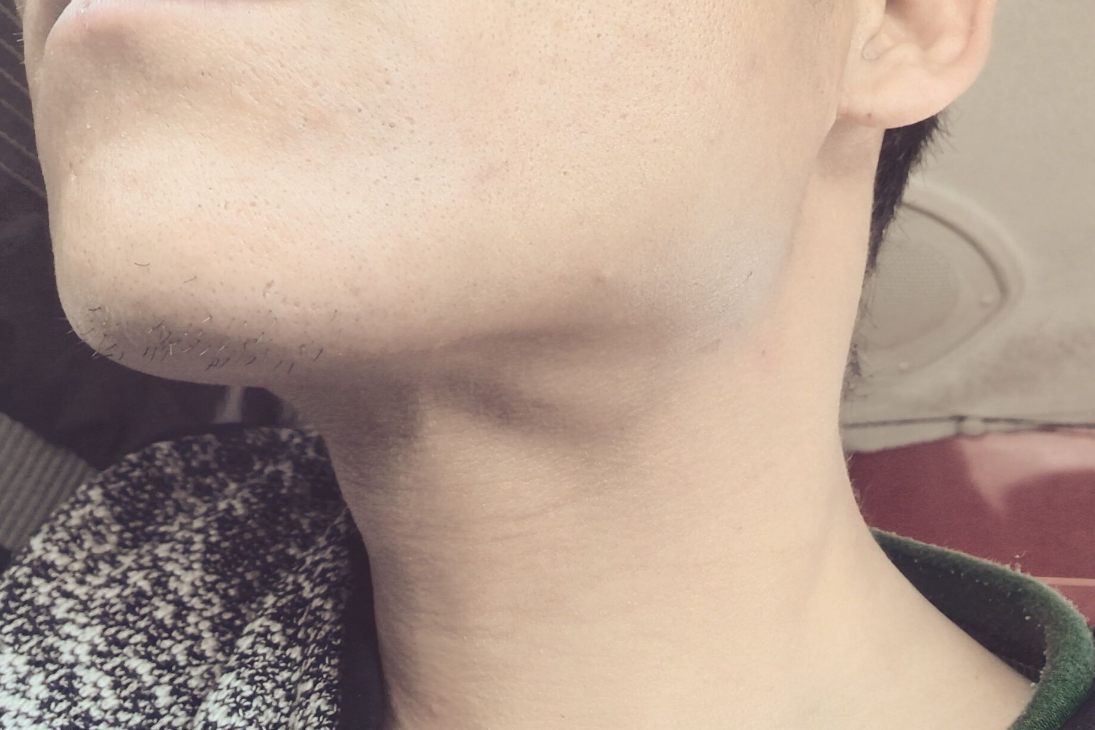 颈部淋巴结肿大