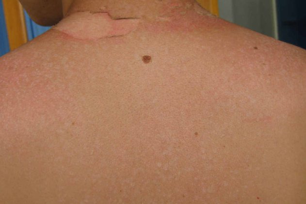 二度紫外线过敏