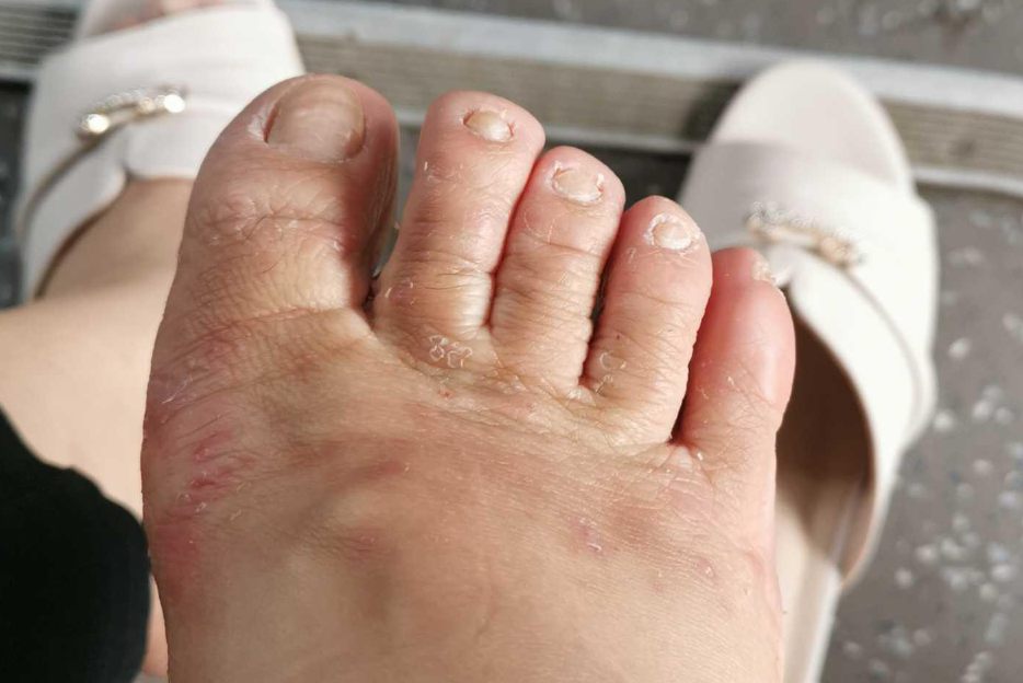 脚趾湿疹