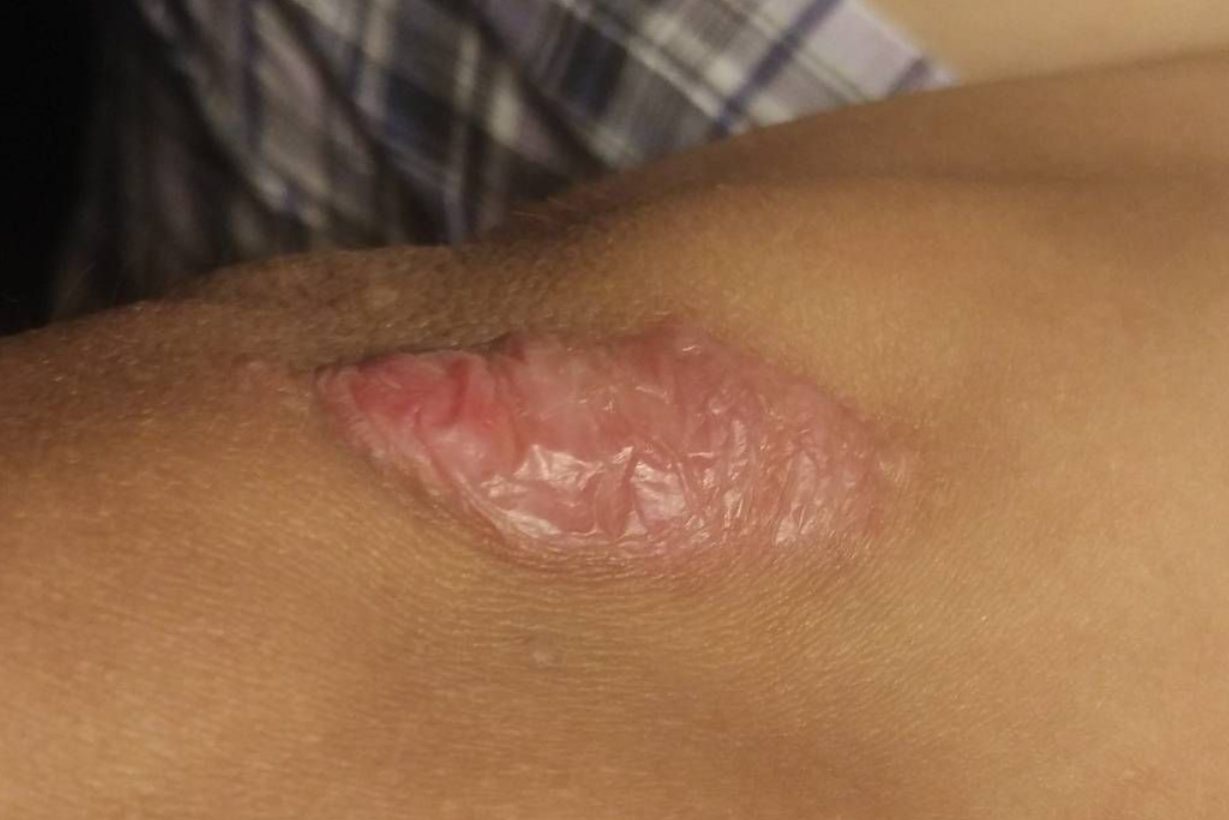 结缔组织增生症