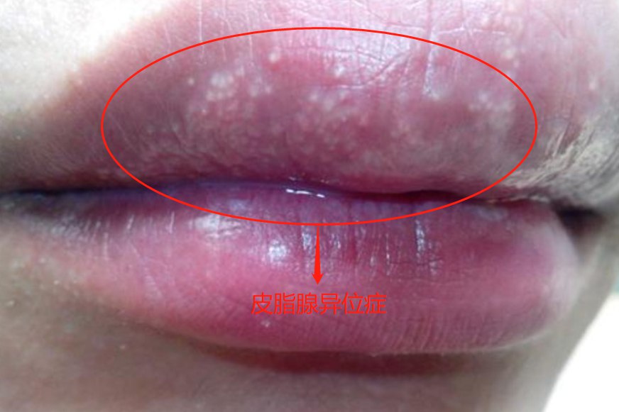 皮脂腺异位症图片