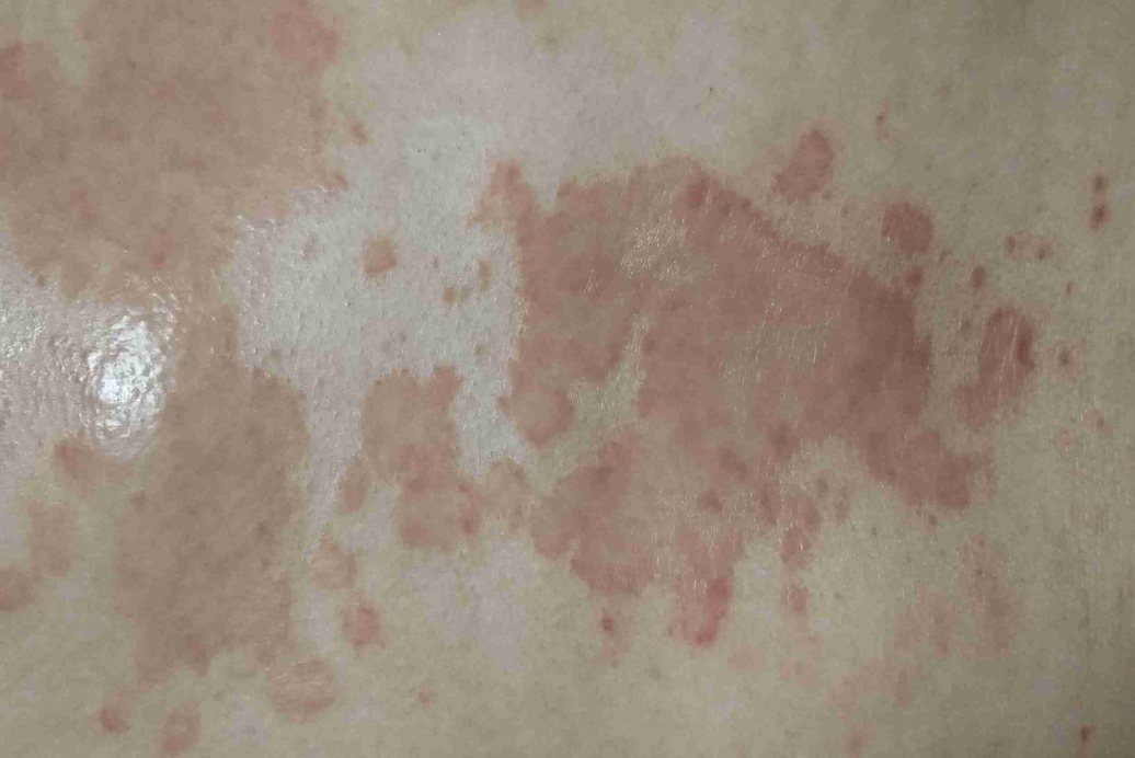 躯干部脂溢性皮炎