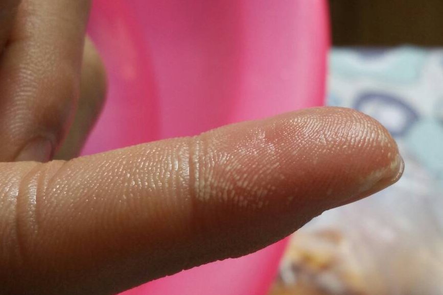 手被氢氧化钠腐蚀