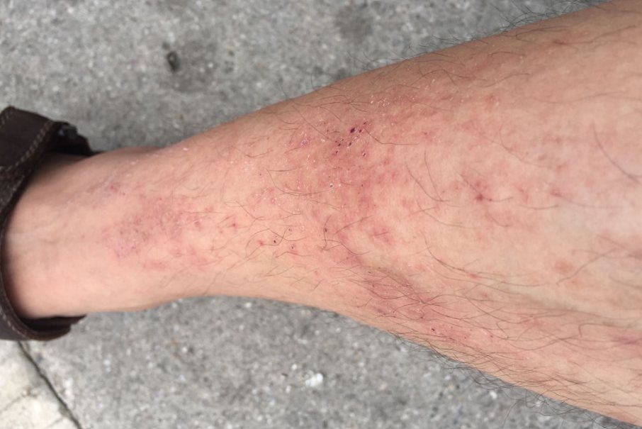 金属过敏性皮炎