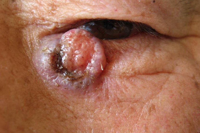 基底细胞乳头瘤