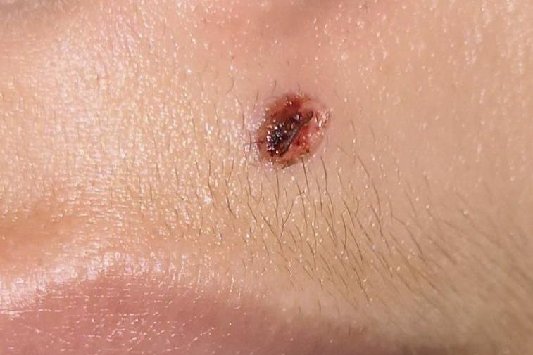 激光去疣结痂自然脱落