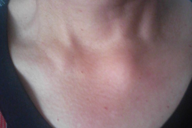 左边锁骨下方骨质增生