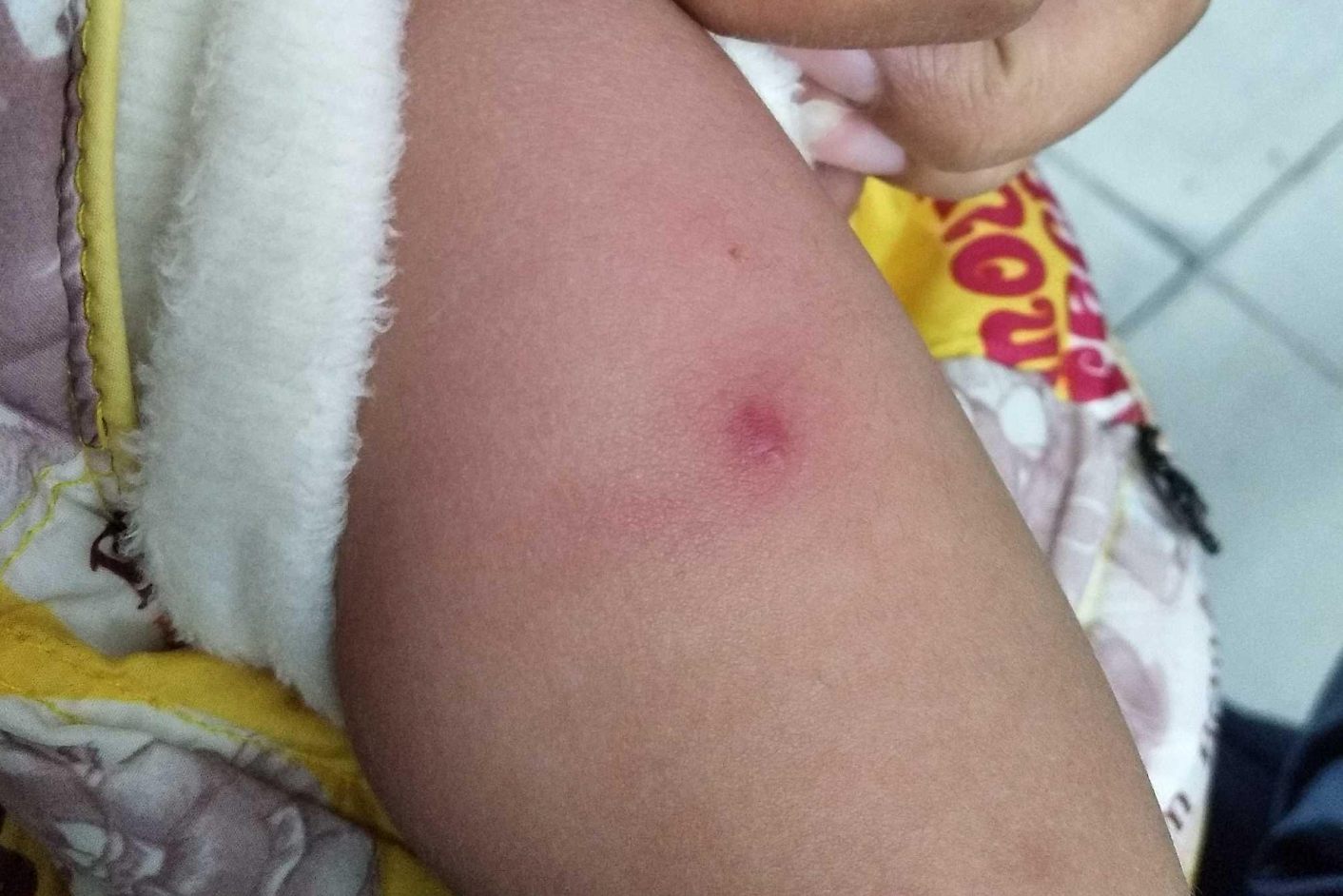 打完预防针胳膊红肿