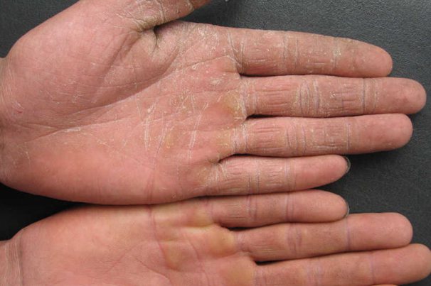 丘疹鳞屑型手癣