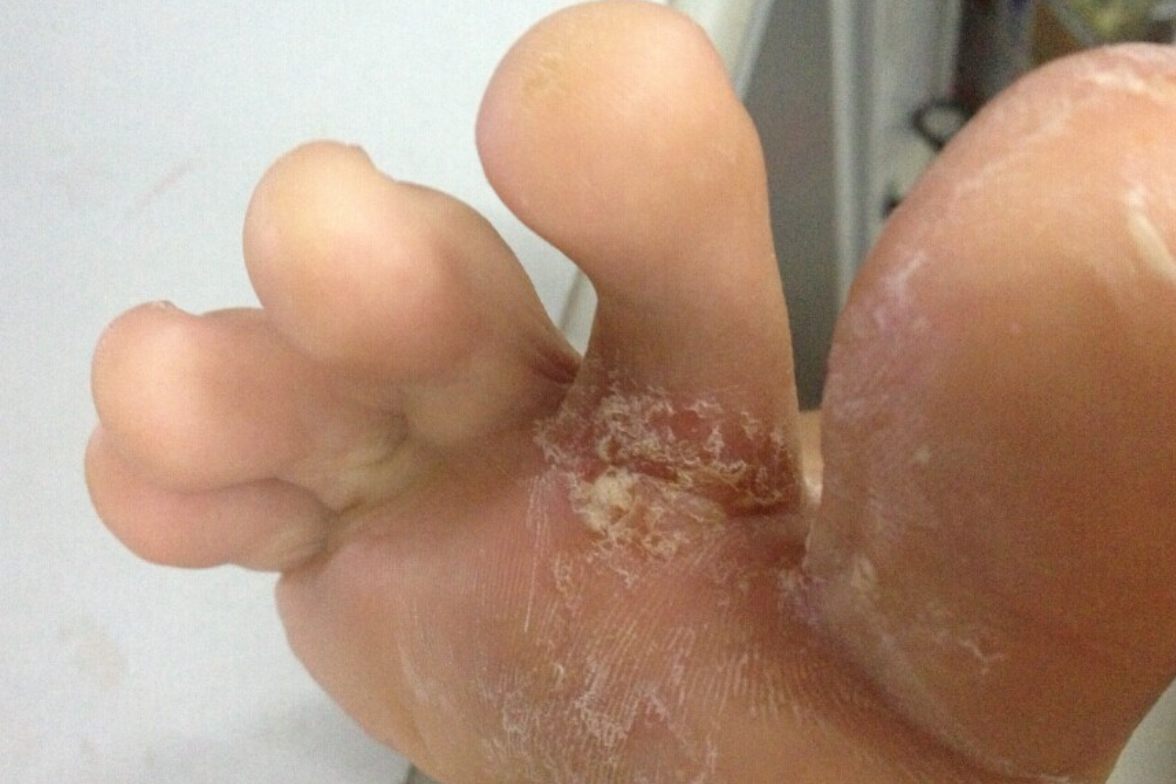 复方土槿皮酊涂完蜕皮