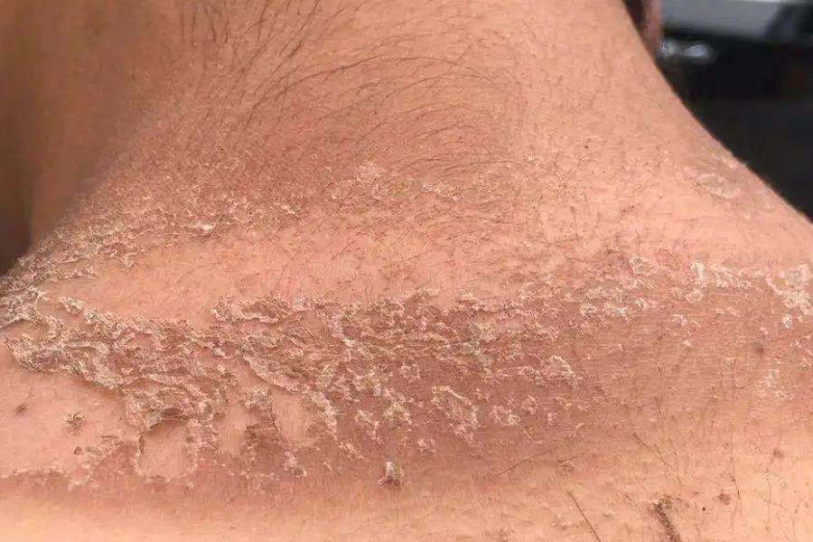 脖子日光性皮炎