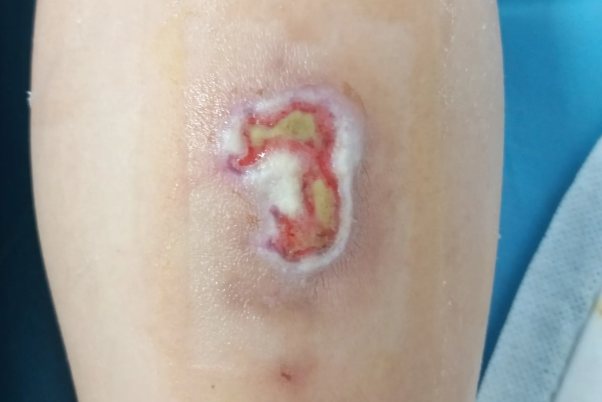 烫伤化脓图片