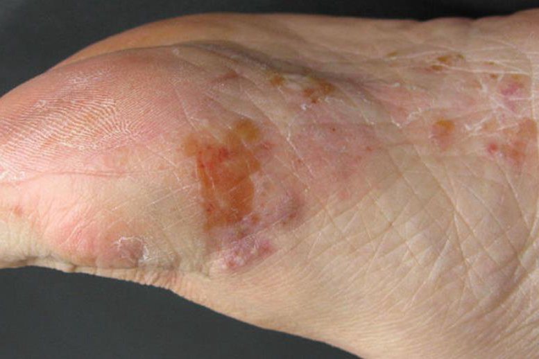 水疱型足癣