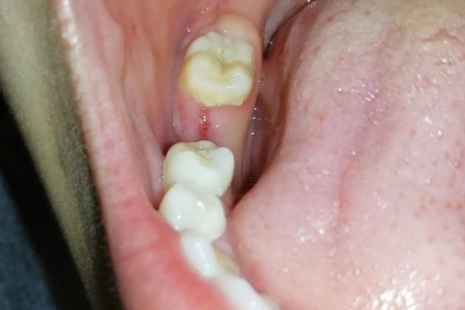 拔牙后七天牙槽窝图片