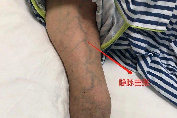 手臂静脉曲张