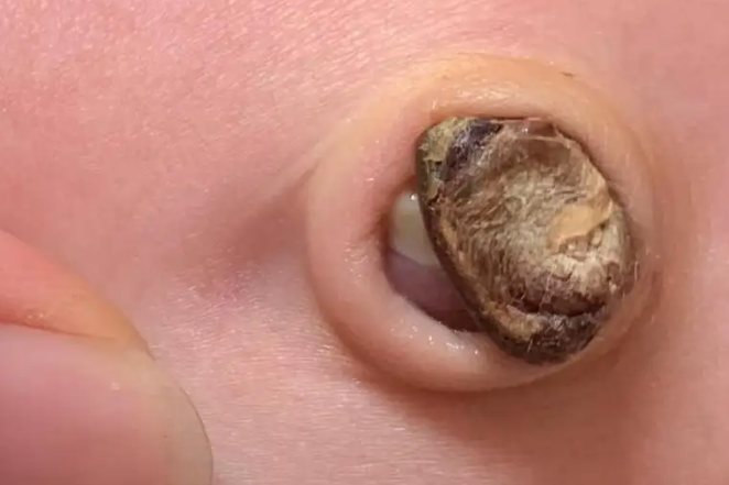 宝宝脐带脱落前兆