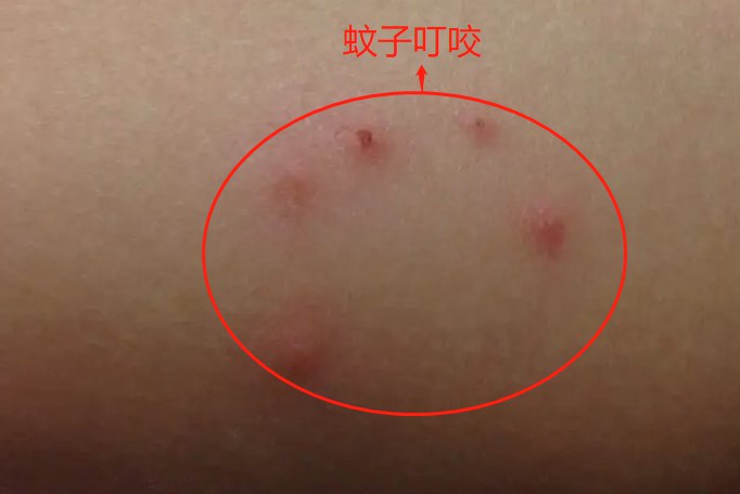 蚊子咬的图片