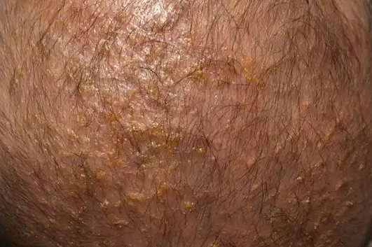 头皮流黄水结痂