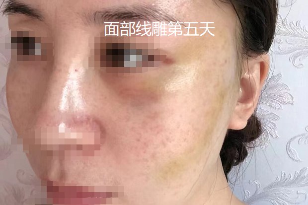 面部线雕第5天