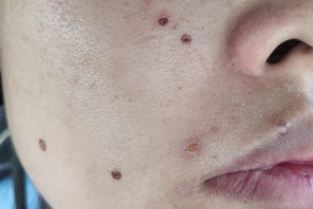 药水点痣正常图片