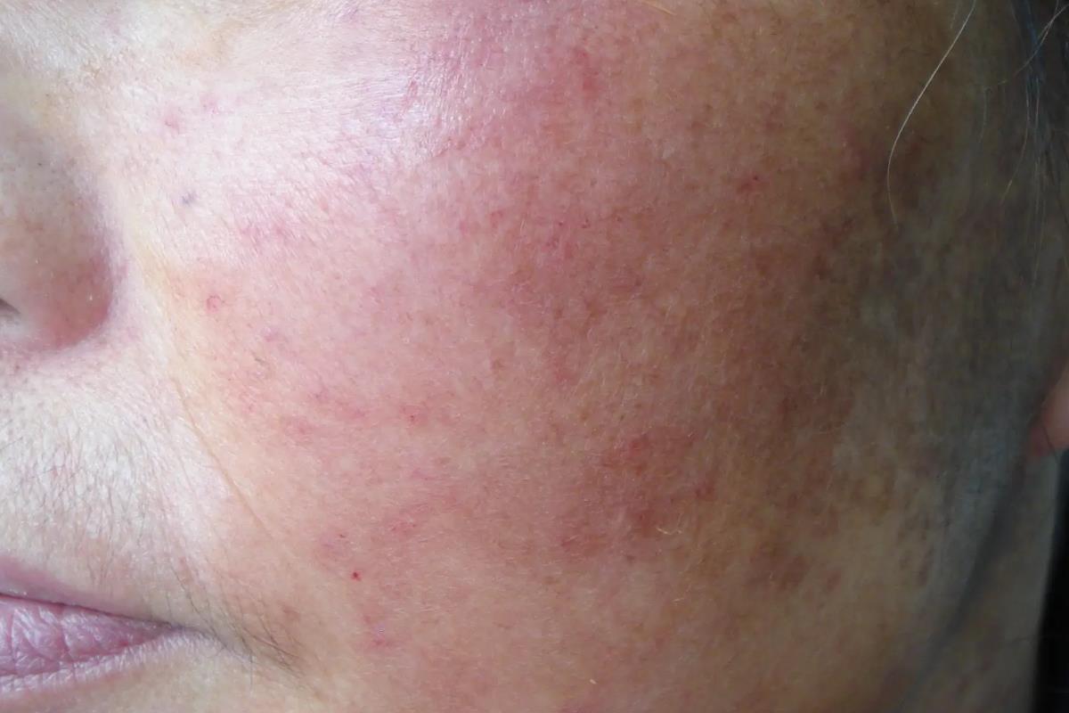 脸部急性过敏性皮炎