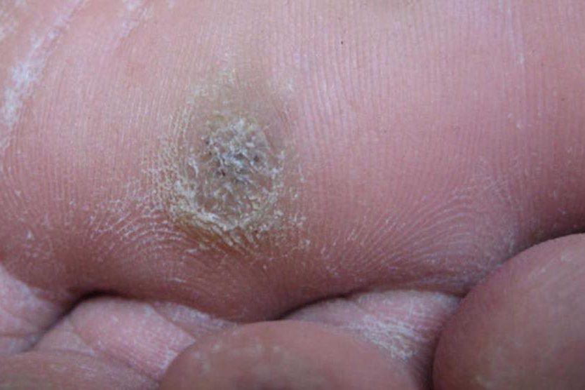 跖疣早期图片