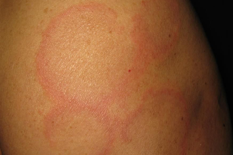 早期环状红斑图