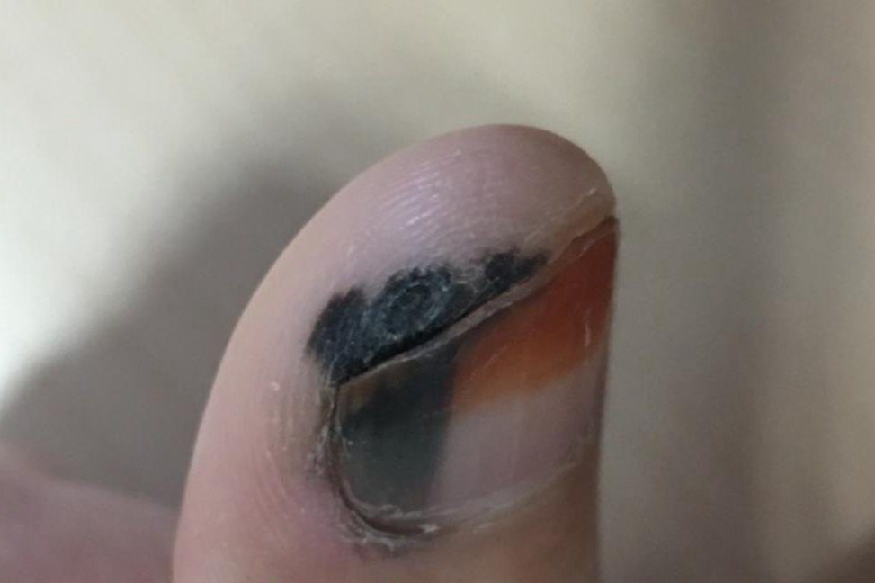 指甲黑线癌症前兆