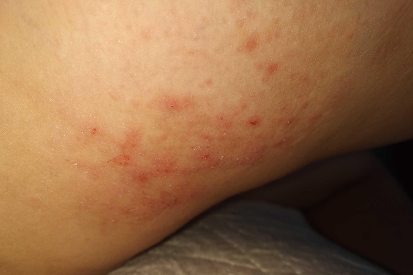 大腿根部湿疹