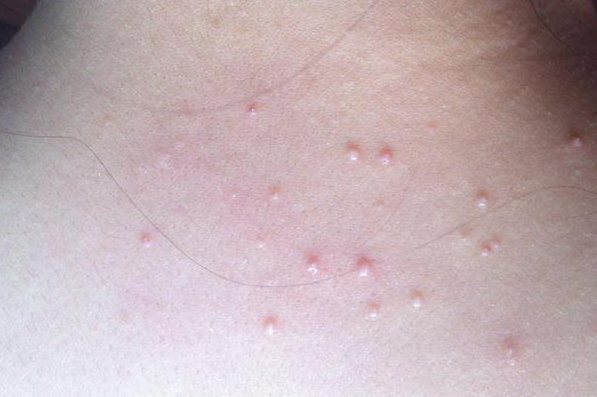 轻微皮肤hpv感染