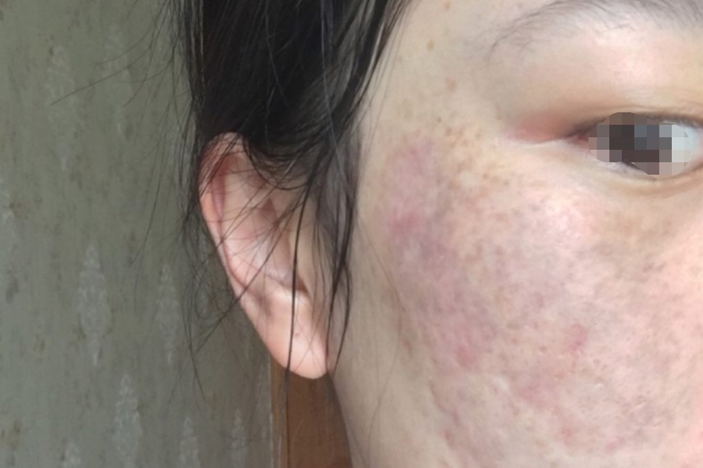 超皮秒祛太田痣第10天