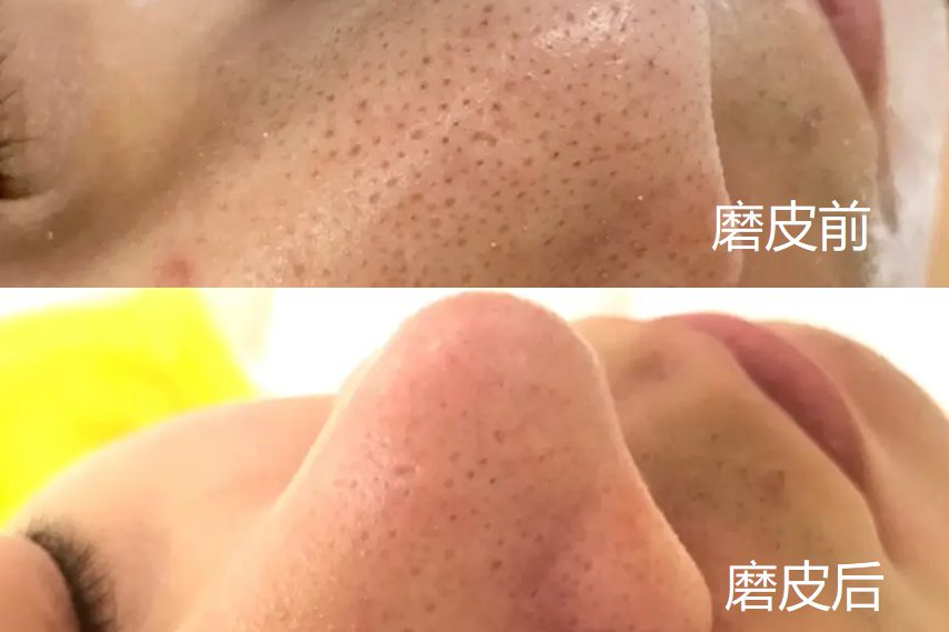 磨皮手术前后对比