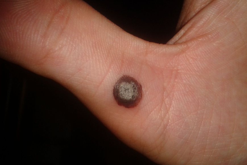 疣体冷冻后的照片