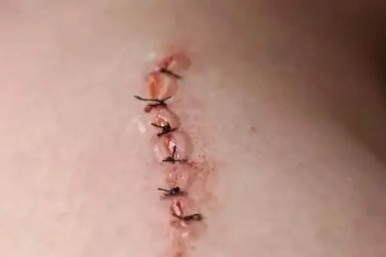 普通针伤口缝合