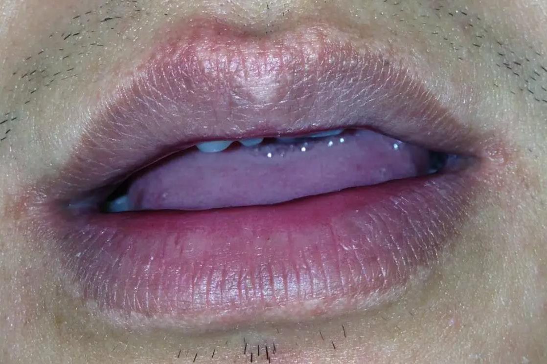 嘴唇上方黑色素沉淀