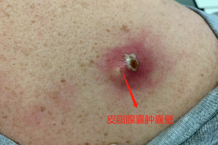 皮脂腺囊肿囊壁图片