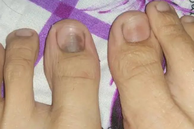 药物引起的黑指甲