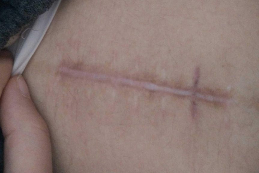 剖腹产疤痕修复前