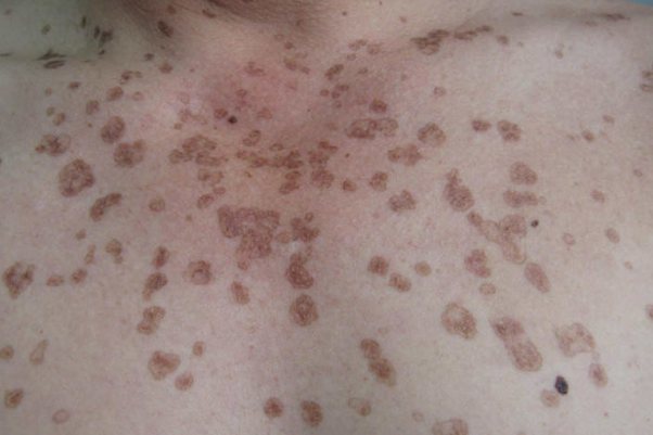 汗孔角化症晚期