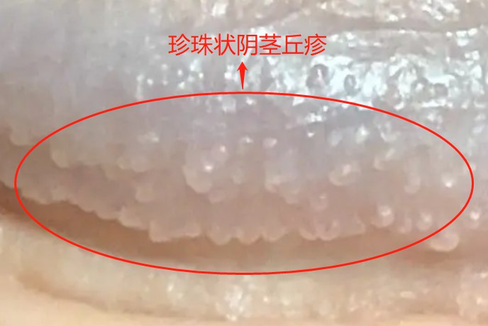 珍珠状阴茎丘疹