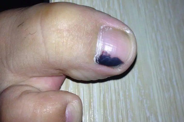 脚趾黑色素瘤早期症状