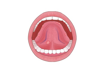 口腔长疣体图片