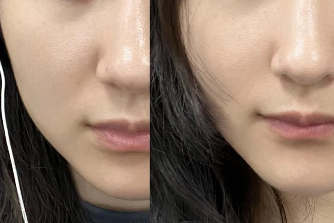 法令纹对比效果图