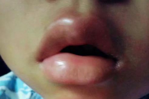 巨大荨麻疹嘴唇肿