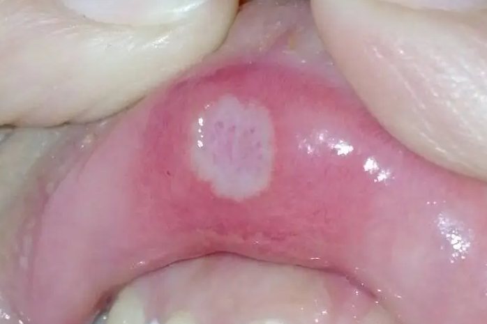 口腔溃疡